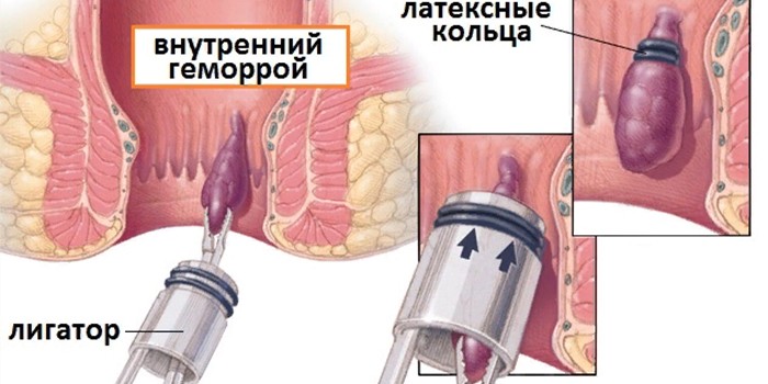 лечение геморроидальных узлов Киев